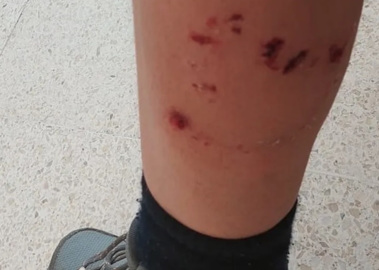 Turista: Andaba en bicicleta y fue atacada por perros en La Angostura (más de lo mismo)