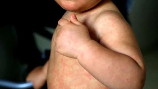 América perdió el estatus de región libre de sarampión: preocupación por los brotes y la baja vacunación