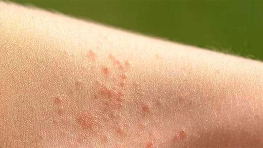 Qué es la miliaria, y cuáles son las cuatro variantes en las que se presenta la enfermedad