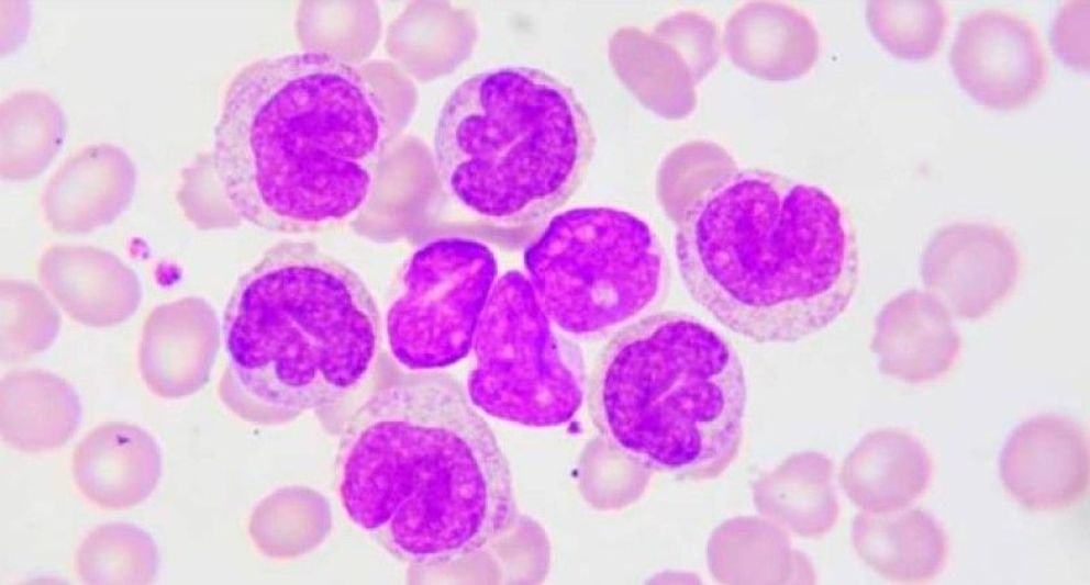 9 de cada 10 pacientes con leucemia linfocítica crónica no reconocen los síntomas antes del diagnóstico